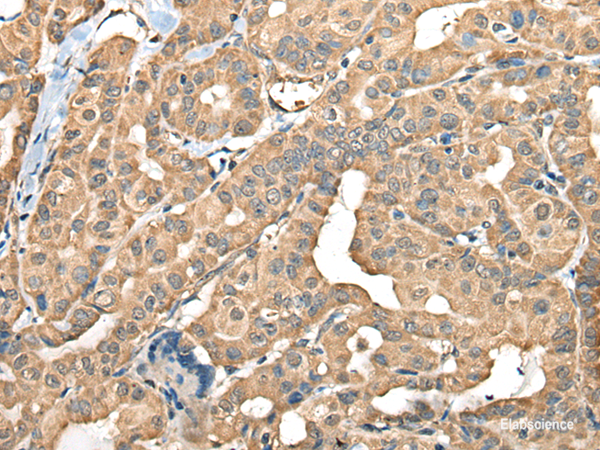Immunohistochemistry of paraffin-embedded Human thyroid cancer tissue  using FAM110B Polyclonal Antibody at dilution of 1:40(×200)