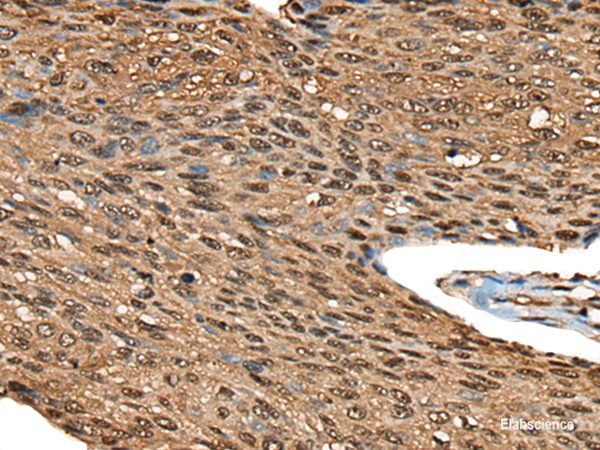 Immunohistochemistry of paraffin-embedded Human esophagus cancer tissue  using CALML5 Polyclonal Antibody at dilution of 1:70(×200)