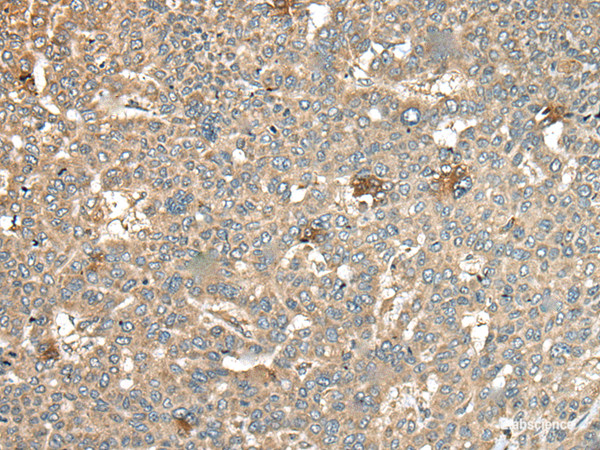Immunohistochemistry of paraffin-embedded Human liver cancer tissue  using CA11 Polyclonal Antibody at dilution of 1:45(×200)