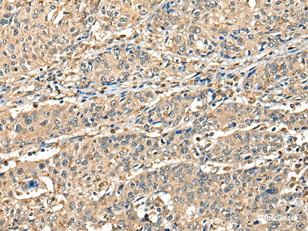 Immunohistochemistry of paraffin-embedded Human prost at e cancer tissue  using CCDC112 Polyclonal Antibody at dilution of 1:45(×200)