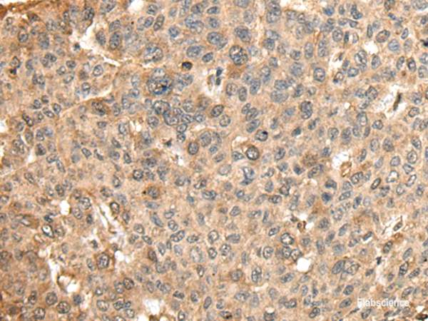 Immunohistochemistry of paraffin-embedded Human liver cancer tissue  using HMMR Polyclonal Antibody at dilution of 1:45(×200)