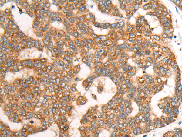 Immunohistochemistry of paraffin-embedded Human liver cancer tissue  using CDON Polyclonal Antibody at dilution of 1:65(×200)