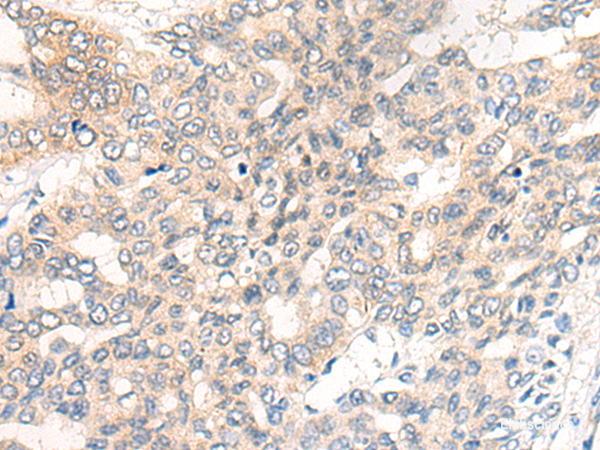 Immunohistochemistry of paraffin-embedded Human liver cancer tissue  using CHRD Polyclonal Antibody at dilution of 1:40(×200)