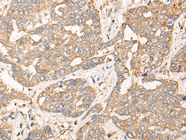 Immunohistochemistry of paraffin-embedded Human liver cancer tissue  using CPNE3 Polyclonal Antibody at dilution of 1:40(×200)