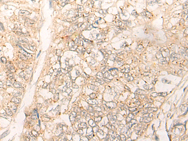 Immunohistochemistry of paraffin-embedded Human gastric cancer tissue  using CUTA Polyclonal Antibody at dilution of 1:40(×200)