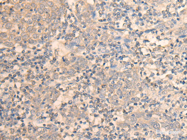 Immunohistochemistry of paraffin-embedded Human cervical cancer tissue  using DAZ1 Polyclonal Antibody at dilution of 1:55(×200)