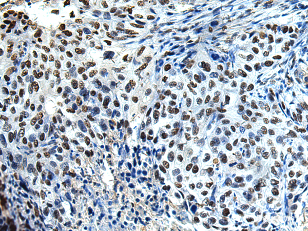 Immunohistochemistry of paraffin-embedded Human esophagus cancer tissue  using DDX39A Polyclonal Antibody at dilution of 1:65(×200)