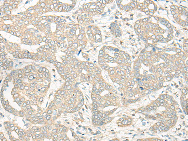 Immunohistochemistry of paraffin-embedded Human liver cancer tissue  using HLA-DRB5 Polyclonal Antibody at dilution of 1:45(×200)