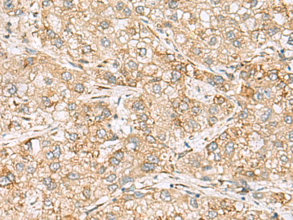 Immunohistochemistry of paraffin-embedded Human liver cancer tissue  using SH3GL2 Polyclonal Antibody at dilution of 1:80(×200)