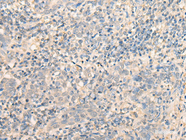 Immunohistochemistry of paraffin-embedded Human cervical cancer tissue  using MR1 Polyclonal Antibody at dilution of 1:40(×200)