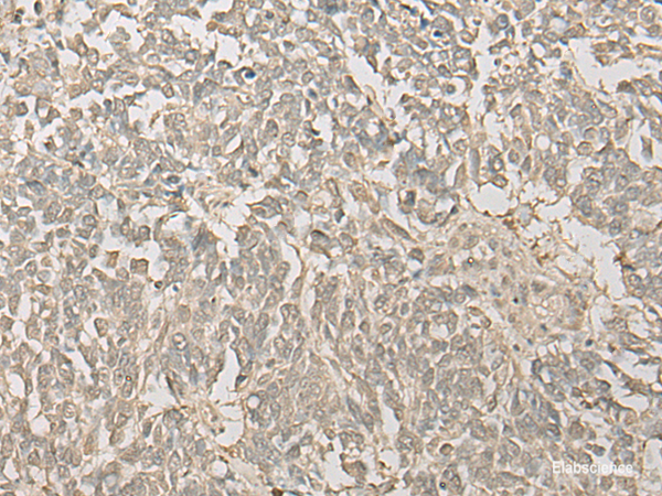 Immunohistochemistry of paraffin-embedded Human lung cancer tissue  using FYTTD1 Polyclonal Antibody at dilution of 1:30(×200)