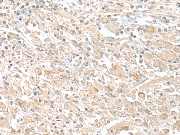 Immunohistochemistry of paraffin-embedded Human liver cancer tissue  using SMS Polyclonal Antibody at dilution of 1:50(×200)