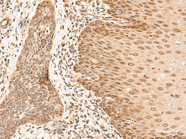 Immunohistochemistry of paraffin-embedded Human esophagus cancer tissue  using ARMC8 Polyclonal Antibody at dilution of 1:40(×200)