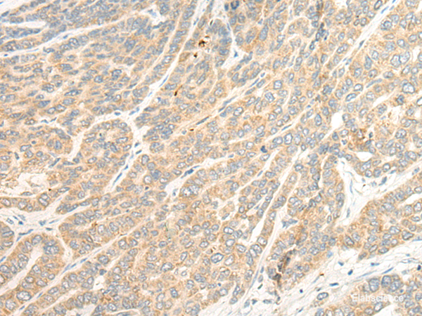 Immunohistochemistry of paraffin-embedded Human liver cancer tissue  using TTC4 Polyclonal Antibody at dilution of 1:45(×200)