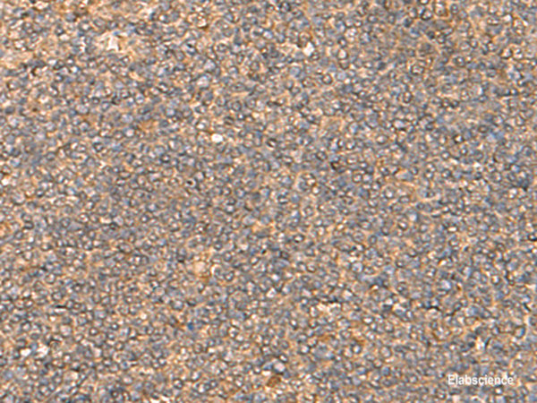 Immunohistochemistry of paraffin-embedded Human tonsil tissue  using DNAJC14 Polyclonal Antibody at dilution of 1:55(×200)