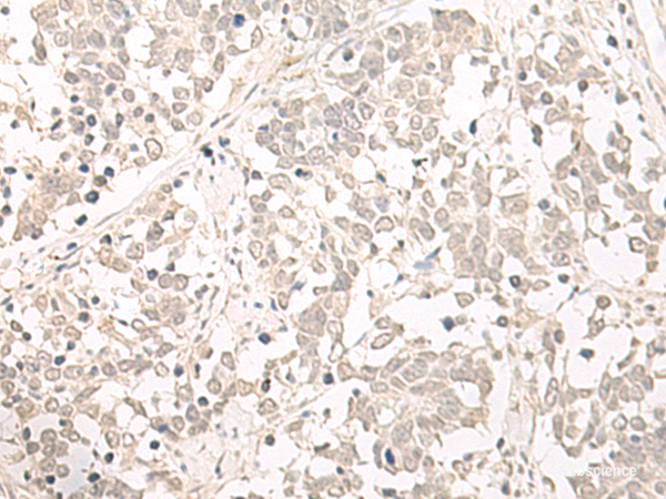 Immunohistochemistry of paraffin-embedded Human lung cancer tissue  using OLA1 Polyclonal Antibody at dilution of 1:55(×200)