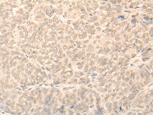 Immunohistochemistry of paraffin-embedded Human ovarian cancer tissue  using NARF Polyclonal Antibody at dilution of 1:45(×200)