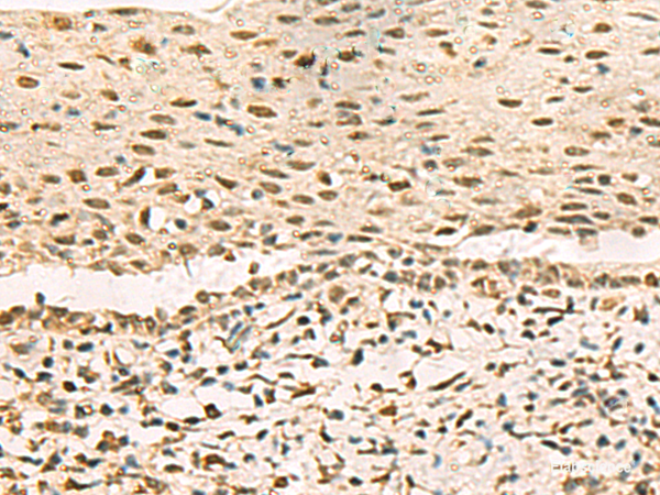 Immunohistochemistry of paraffin-embedded Human cervical cancer tissue  using GRWD1 Polyclonal Antibody at dilution of 1:90(×200)
