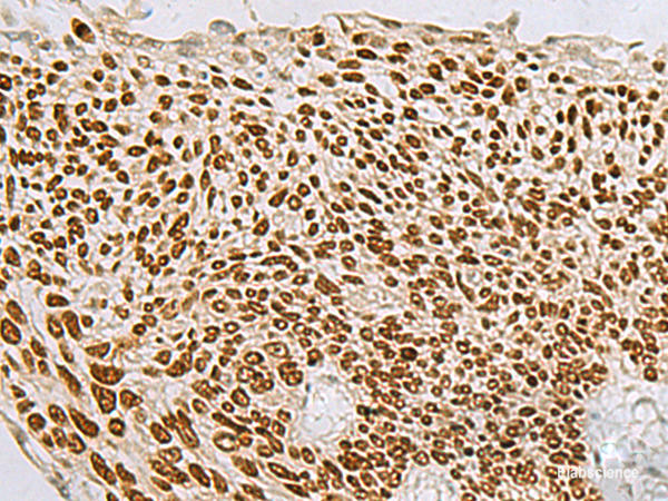Immunohistochemistry of paraffin-embedded Human lung cancer tissue  using TP63 Polyclonal Antibody at dilution of 1:65(×200)