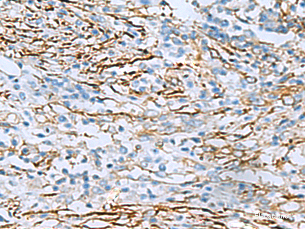 Immunohistochemistry of paraffin-embedded Human breast cancer tissue  using DPYSL3 Polyclonal Antibody at dilution of 1:55(×200)