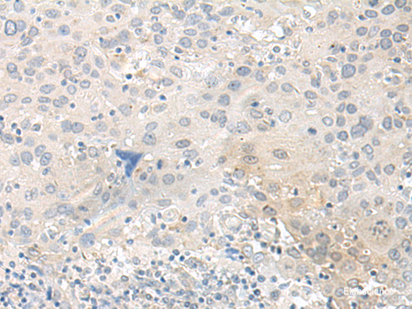 Immunohistochemistry of paraffin-embedded Human cervical cancer tissue  using TUBG2 Polyclonal Antibody at dilution of 1:50(×200)