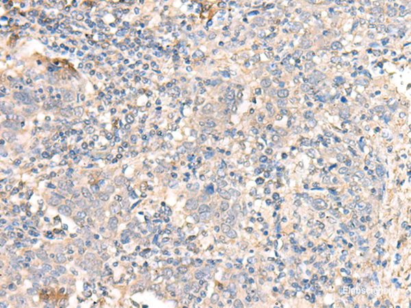 Immunohistochemistry of paraffin-embedded Human cervical cancer tissue  using PARS2 Polyclonal Antibody at dilution of 1:30(×200)