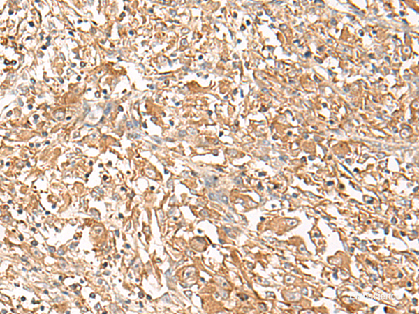Immunohistochemistry of paraffin-embedded Human liver cancer tissue  using CORO2A Polyclonal Antibody at dilution of 1:50(×200)