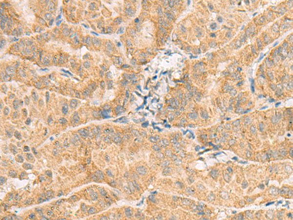 Immunohistochemistry of paraffin-embedded Human thyroid cancer tissue  using NCOA4 Polyclonal Antibody at dilution of 1:130(×200)
