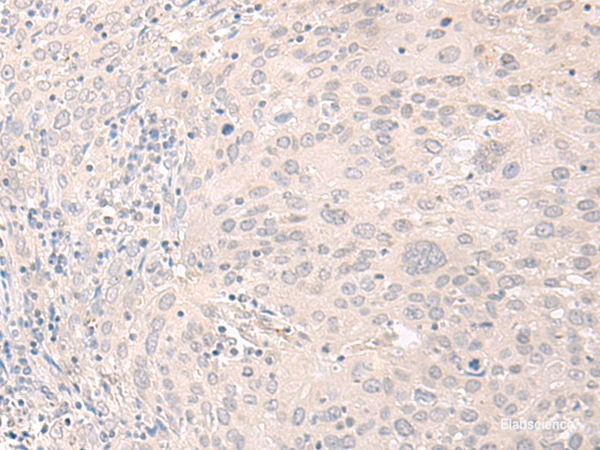 Immunohistochemistry of paraffin-embedded Human cervical cancer tissue  using FOXRED2 Polyclonal Antibody at dilution of 1:35(×200)