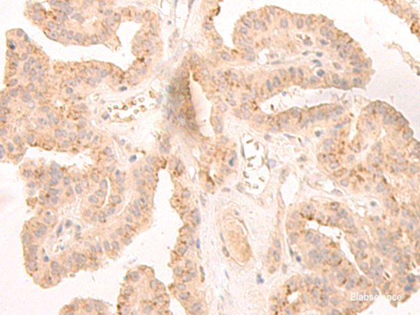 Immunohistochemistry of paraffin-embedded Human thyroid cancer tissue  using LCMT2 Polyclonal Antibody at dilution of 1:45(×200)