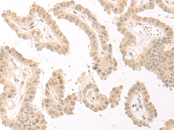 Immunohistochemistry of paraffin-embedded Human thyroid cancer tissue  using PBXIP1 Polyclonal Antibody at dilution of 1:40(×200)