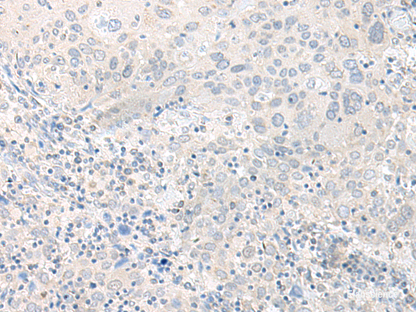 Immunohistochemistry of paraffin-embedded Human cervical cancer tissue  using TIMM8A Polyclonal Antibody at dilution of 1:50(×200)