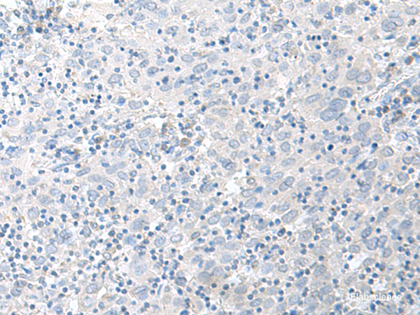 Immunohistochemistry of paraffin-embedded Human cervical cancer tissue  using STAU2 Polyclonal Antibody at dilution of 1:45(×200)