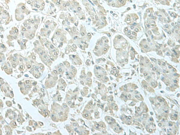 Immunohistochemistry of paraffin-embedded Human gastric cancer tissue  using C8orf4 Polyclonal Antibody at dilution of 1:55(×200)