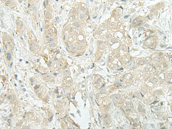 Immunohistochemistry of paraffin-embedded Human breast cancer tissue  using MIEN1 Polyclonal Antibody at dilution of 1:45(×200)