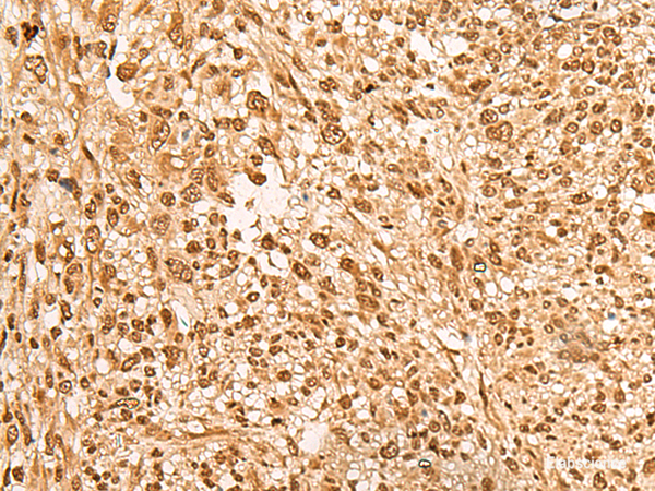 Immunohistochemistry of paraffin-embedded Human liver cancer tissue  using JPT2 Polyclonal Antibody at dilution of 1:65(×200)