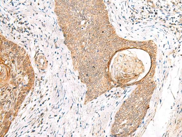 Immunohistochemistry of paraffin-embedded Human esophagus cancer tissue  using TOR1A Polyclonal Antibody at dilution of 1:35(×200)