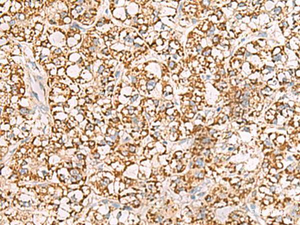 Immunohistochemistry of paraffin-embedded Human liver cancer tissue  using ISOC2 Polyclonal Antibody at dilution of 1:95(×200)