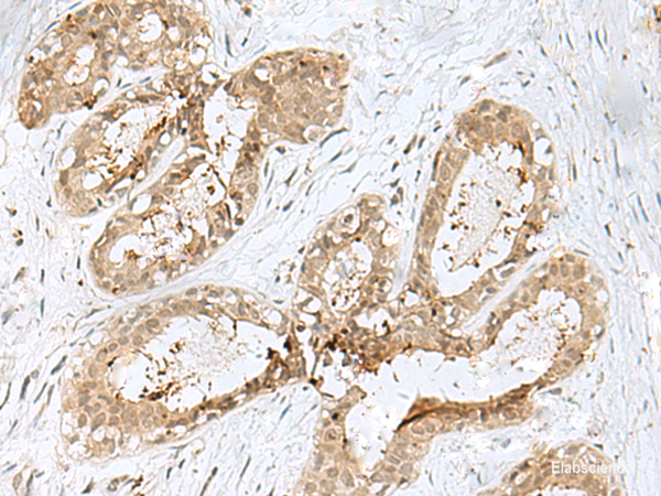 Immunohistochemistry of paraffin-embedded Human breast cancer tissue  using PSMA4 Polyclonal Antibody at dilution of 1:45(×200)