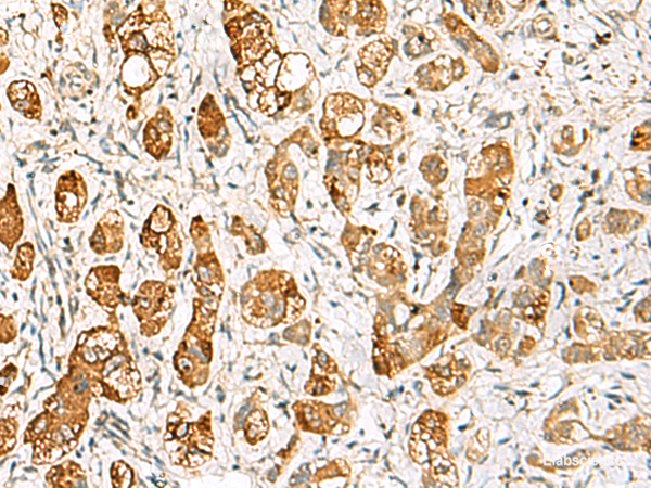 Immunohistochemistry of paraffin-embedded Human liver cancer tissue  using RIMS3 Polyclonal Antibody at dilution of 1:60(×200)