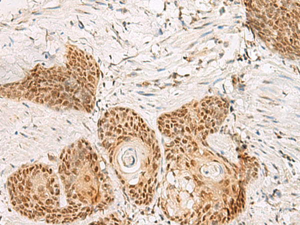 Immunohistochemistry of paraffin-embedded Human esophagus cancer tissue  using PSPC1 Polyclonal Antibody at dilution of 1:30(×200)