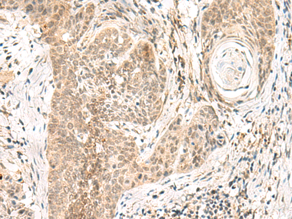 Immunohistochemistry of paraffin-embedded Human esophagus cancer tissue  using GPSM1 Polyclonal Antibody at dilution of 1:55(×200)