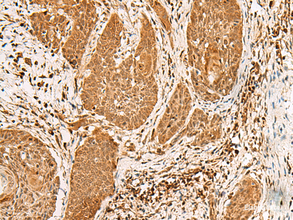 Immunohistochemistry of paraffin-embedded Human esophagus cancer tissue  using PPOX Polyclonal Antibody at dilution of 1:30(×200)