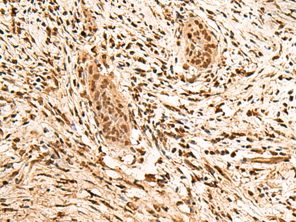 Immunohistochemistry of paraffin-embedded Human esophagus cancer tissue  using PPM1G Polyclonal Antibody at dilution of 1:40(×200)