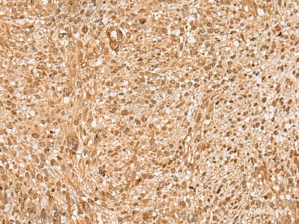 Immunohistochemistry of paraffin-embedded Human liver cancer tissue  using HIRIP3 Polyclonal Antibody at dilution of 1:60(×200)