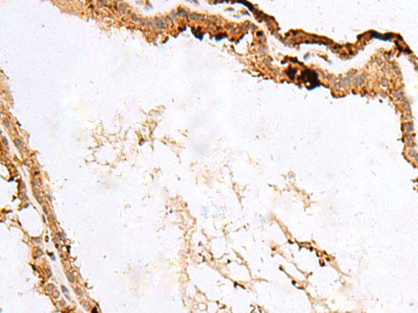 Immunohistochemistry of paraffin-embedded Human thyroid cancer tissue  using RABGGTA Polyclonal Antibody at dilution of 1:50(×200)