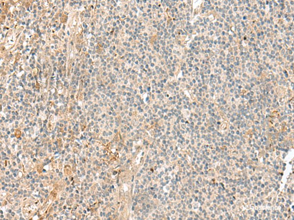 Immunohistochemistry of paraffin-embedded Human tonsil tissue  using NGEF Polyclonal Antibody at dilution of 1:35(×200)