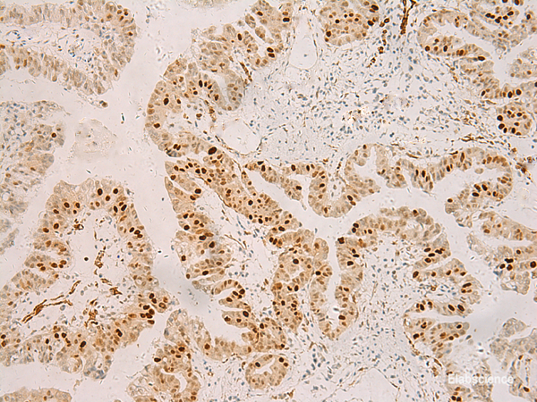 Immunohistochemistry of paraffin-embedded Human liver cancer tissue  using RFX6 Polyclonal Antibody at dilution of 1:50(×200)