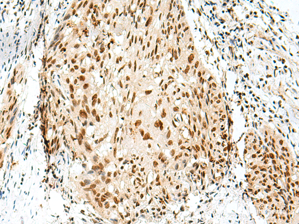 Immunohistochemistry of paraffin-embedded Human esophagus cancer tissue  using RBM10 Polyclonal Antibody at dilution of 1:55(×200)