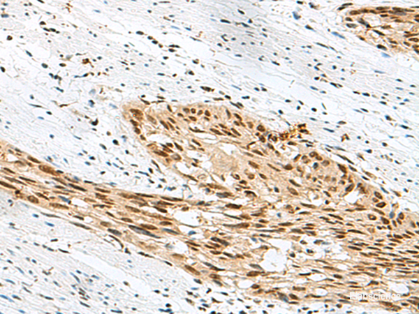 Immunohistochemistry of paraffin-embedded Human esophagus cancer tissue  using RBM12 Polyclonal Antibody at dilution of 1:50(×200)